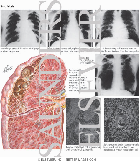 Sarcoidosis
