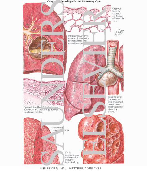 Congenital Bronchogenic and Pulmonary Cysts