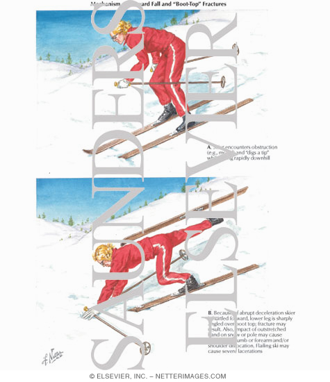 Mechanism of Forward Fall and
