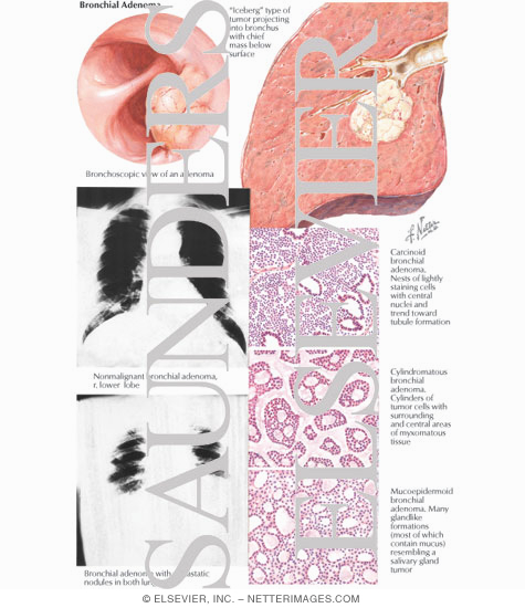Bronchial Adenoma