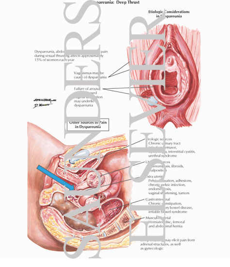 Dyspareunia: Deep Thrust
