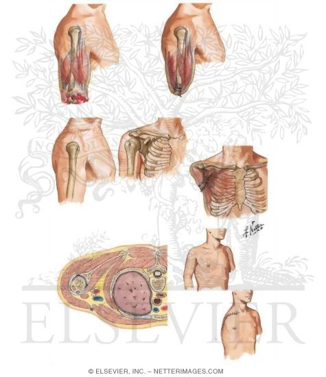 Amputation of Upper Arm and Shoulder