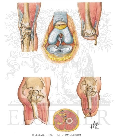 Disarticulation of Knee and Above-Knee Amputation