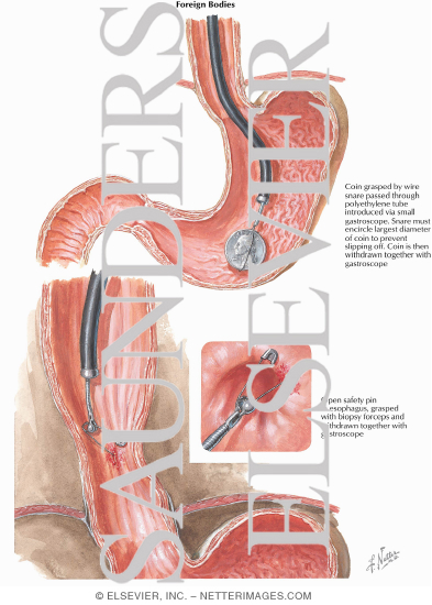 Watermarked preview of unlabeled image: Foreign Bodies