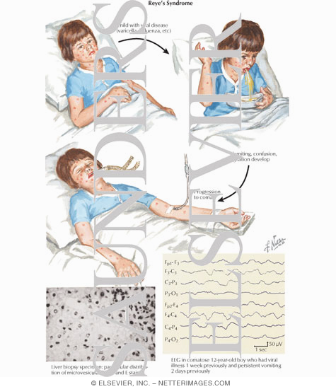 Reye's Syndrome