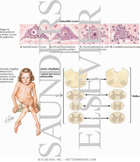 Watermarked preview of labeled image: Poliomyelitis