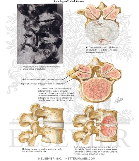 Watermarked preview of labeled image: Pathology of Spinal Stenosis