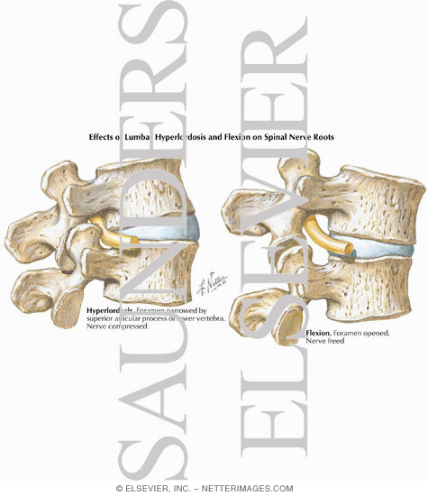 Watermarked preview of labeled image: Effects of Lumbar Hyperlordosis and Flexion on Spinal Nerve Roots