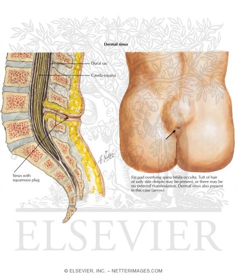 Spinal Dysraphism