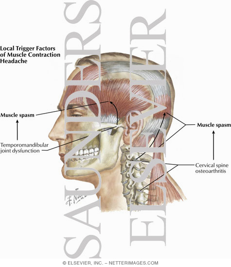 Watermarked preview of labeled image: Local Trigger Factors of Muscle Contraction Headache