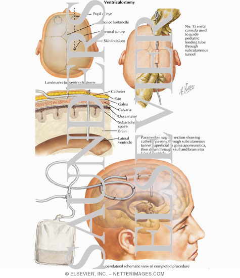 Watermarked preview of labeled image: Ventriculostomy