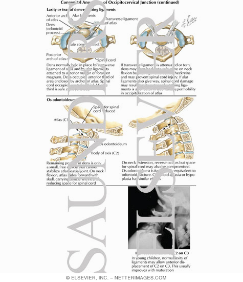 Watermarked preview of labeled image: Congenital Anomalies of Occipitocervical Junction