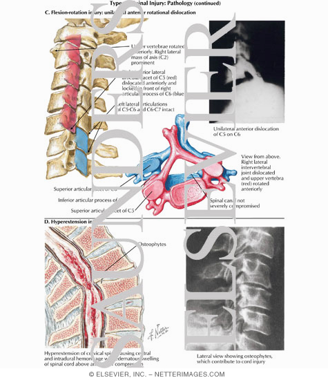 Fracture and Dislocation of Cervical Vertebrae