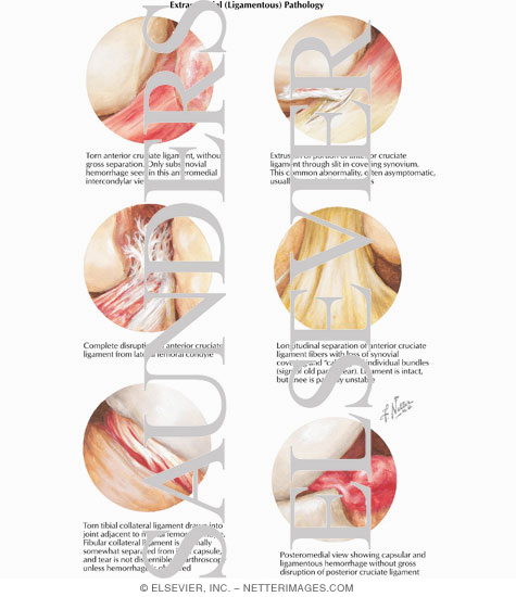 Extrasynovial (Ligamentous) Pathology