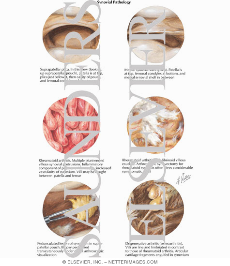 Watermarked preview of labeled image: Synovial Pathology   