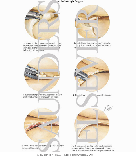 Watermarked preview of labeled image: Meniscal Arthroscopic Surgery