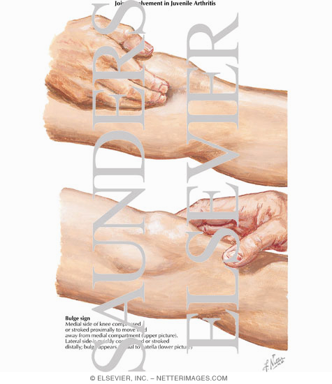 Watermarked preview of labeled image: Joint Involvement in Juvenile Arthritis