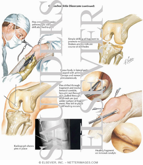 Watermarked preview of labeled image: Osteochondritis Dissecans
Anthroscopic Treatments