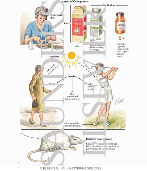 Watermarked preview of labeled image: Treatment of Osteoporosis
