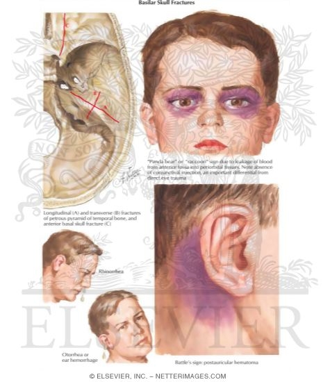 Basilar Skull Fractures