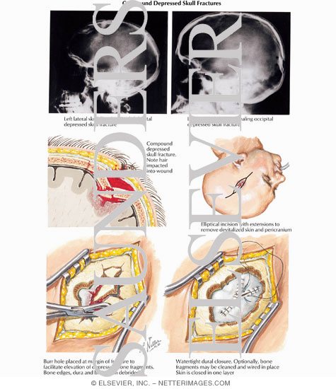 Watermarked preview of labeled image: Compound Depressed Skull Fractures
