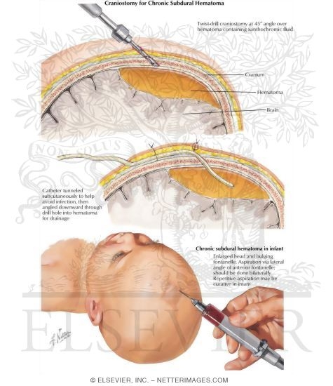 Craniostomy for Chronic Subdural Hematoma
