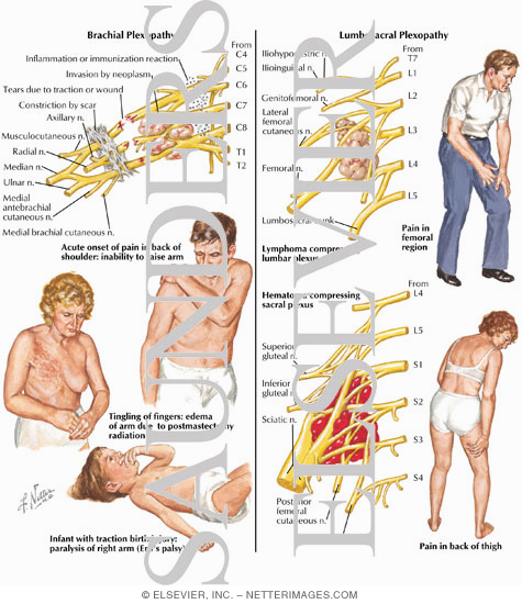 Watermarked preview of labeled image: Brachial Plexopathy