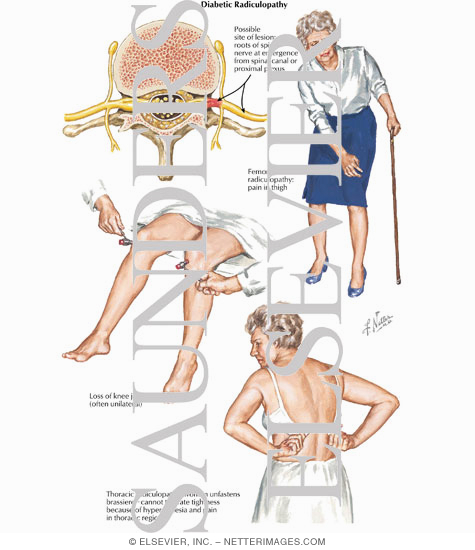 Diabetic Radiculopathy