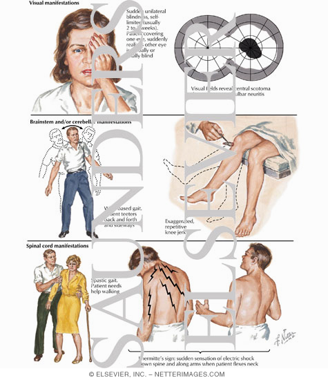Watermarked preview of labeled image: Multiple Sclerosis: Clinical Manifestations