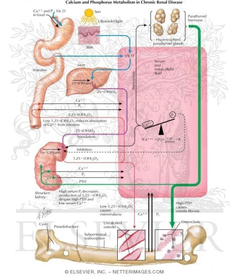 Watermarked preview of labeled image: Metabolic Aberrations of Renal Osteodystrophy
