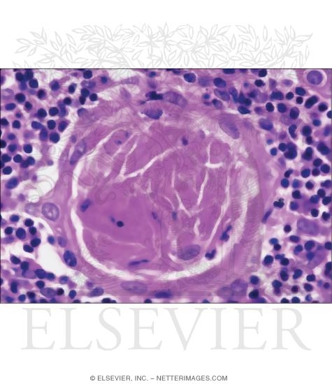 Light Micrograph of Hassall’s Corpuscle at Higher Magnification