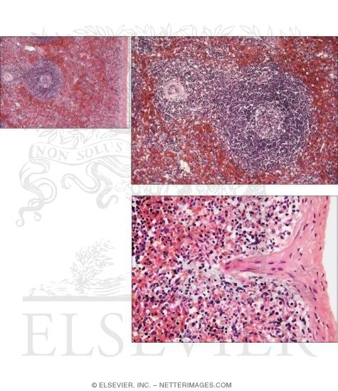 Low-magnification Light Micrograph of Part of the Spleen With Light Micrograph of White Pulp and Light Micrograph of the Capsule of the Spleen and Underlying Red Pulp