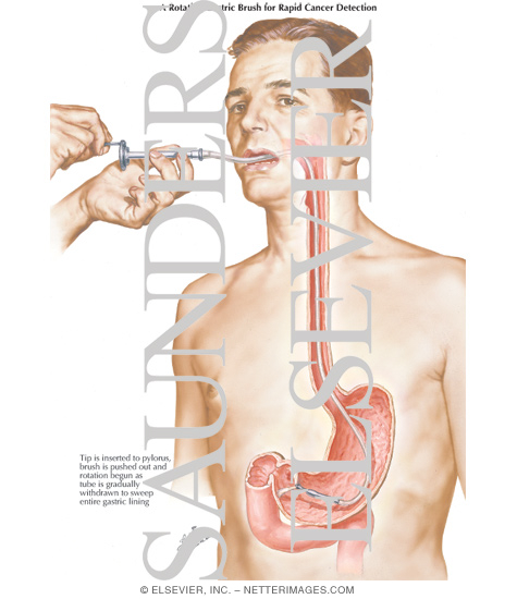 Watermarked preview of labeled image: Gastroscopic Diagnosis of Malignant Disease