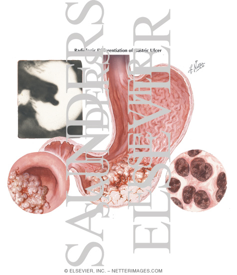 Watermarked preview of labeled image: Gastric Ulcer