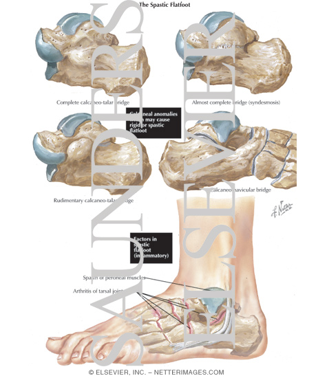 Watermarked preview of labeled image: Spastic Flatfoot