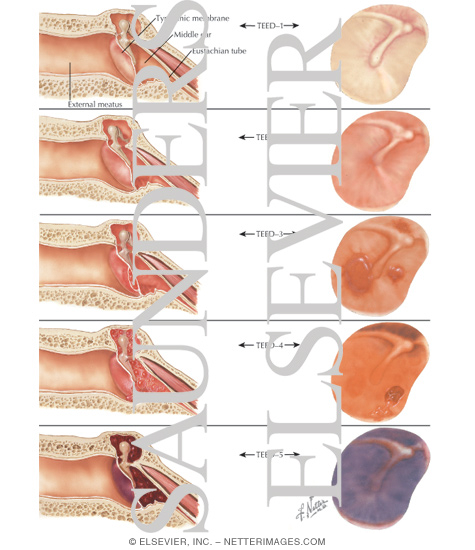 Watermarked preview of labeled image: Degrees of Aerotitis Produced By Pressure Differential