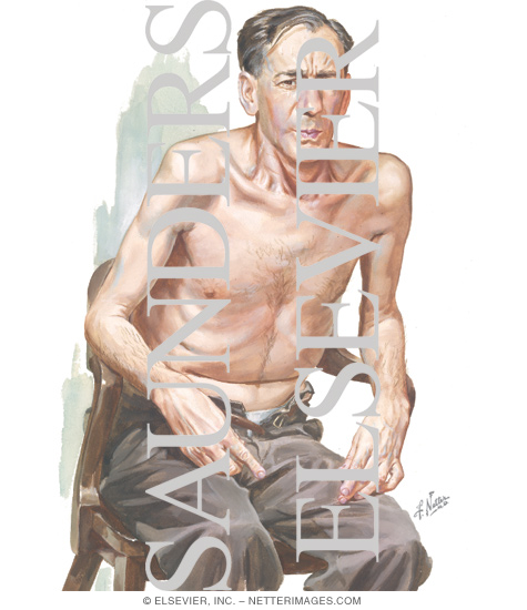 Emphysema Patient and the Position Often Assumed