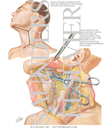 Watermarked preview of labeled image: Radical Neck Dissection