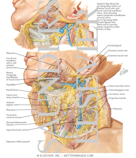 Radical Neck Dissection