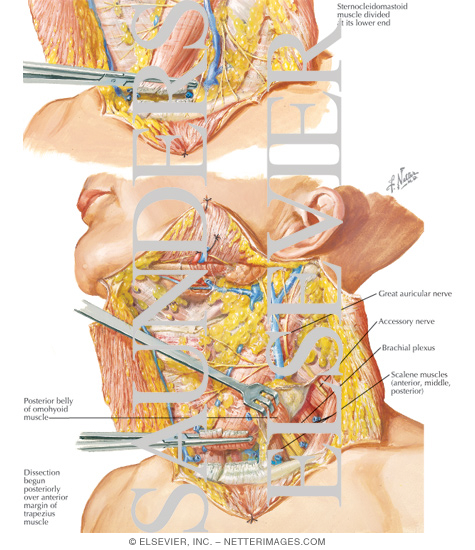 Radical Neck Dissection