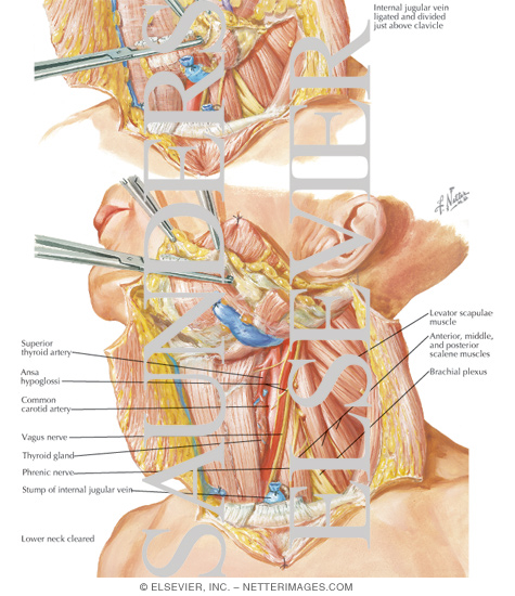 Radical Neck Dissection