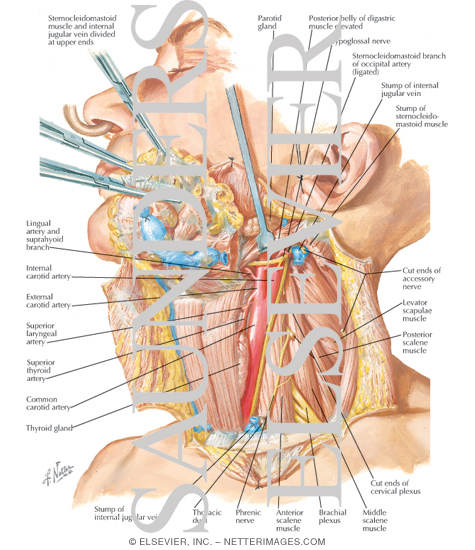 Radical Neck Dissection