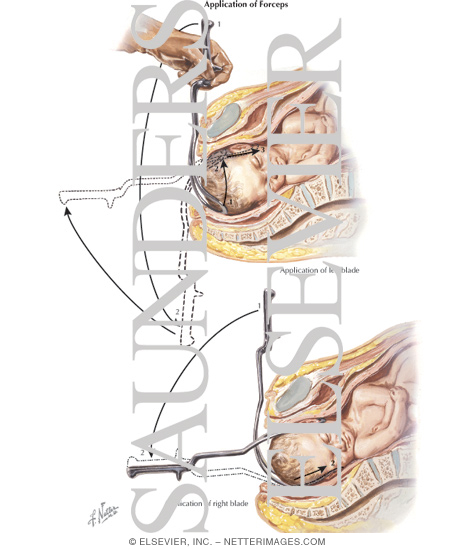Watermarked preview of labeled image: Application of Forceps (Left and Right Blade)