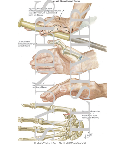 Fractures and Dislocations of Thumb