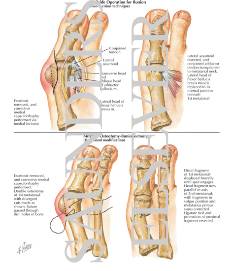 Watermarked preview of labeled image: Ureteral Strictures