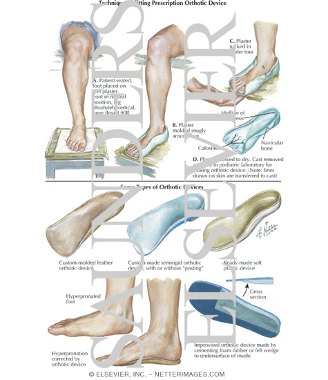 Orthotic fitting deals