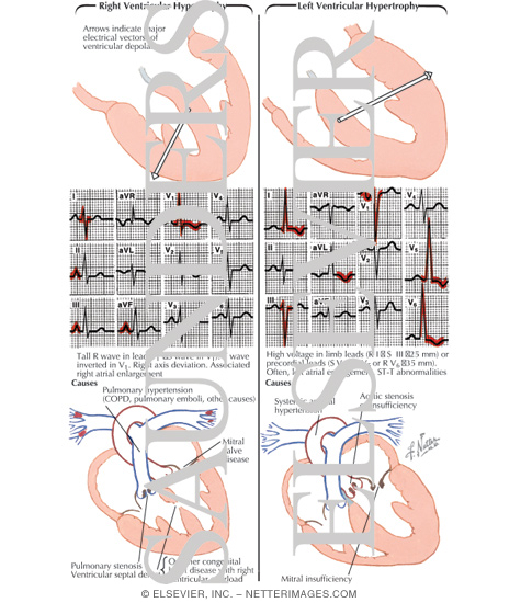 Right Ventricular Hypertrophy and Left Ventricluar Hypertrophy