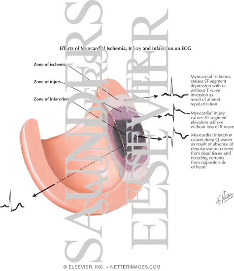 Watermarked preview of labeled image: Effects of Myocardial Ischemia, Injury and Infarction on ECG