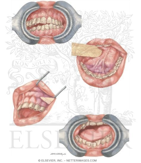 Facial Trauma: Purple Gums