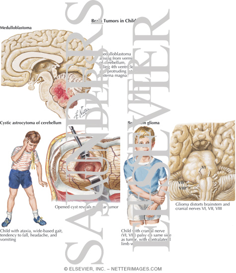 Watermarked preview of labeled image: Brain Tumors In Children